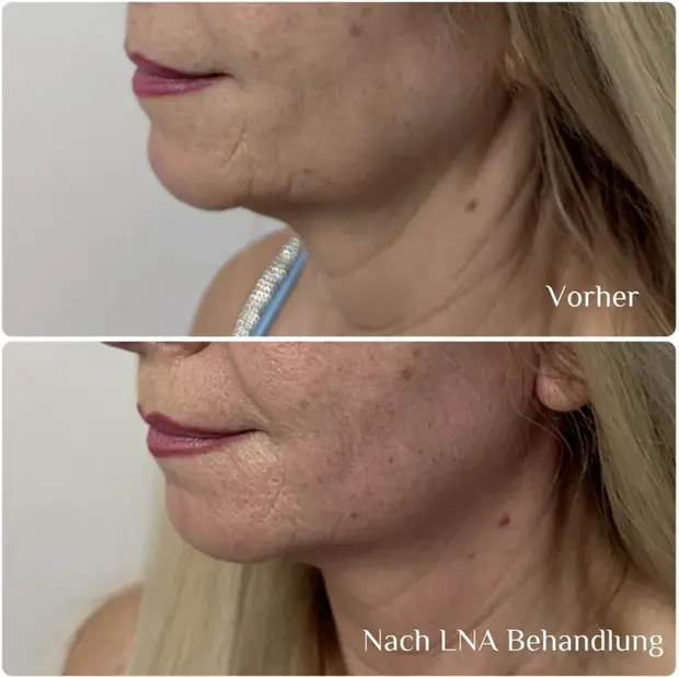 Vorher und nachher: Kieferlinie und Hals